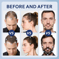 Artimore aplicación en cuero cabelludo, ayuda a distribuir minoxidil en zonas finas