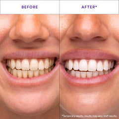HISMILE V34 tira morada adherida a dientes, aplicación estable y cómoda