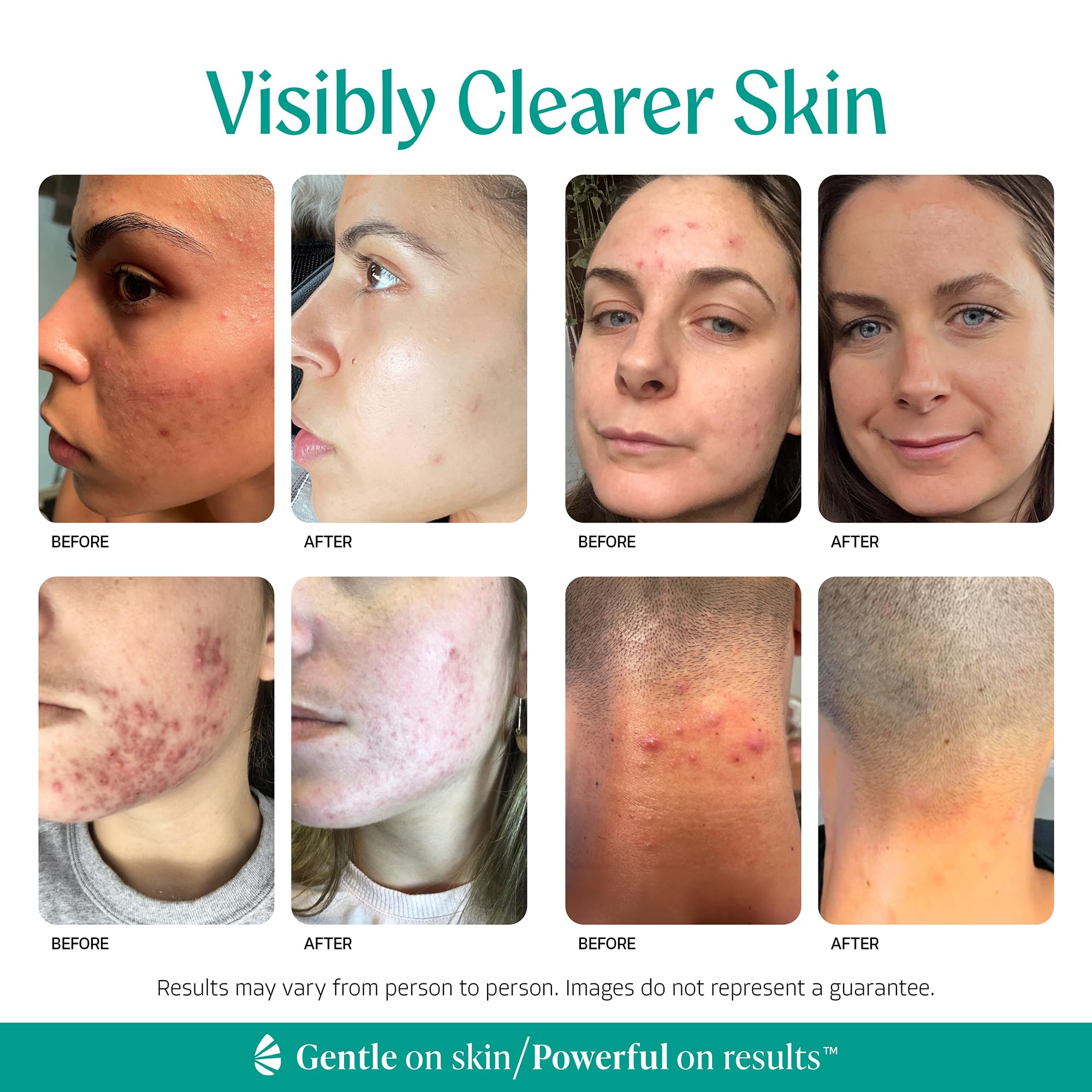 Almond Clear aplicación en espalda para reducir foliculitis