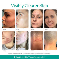 Almond Clear aplicación en espalda para reducir foliculitis