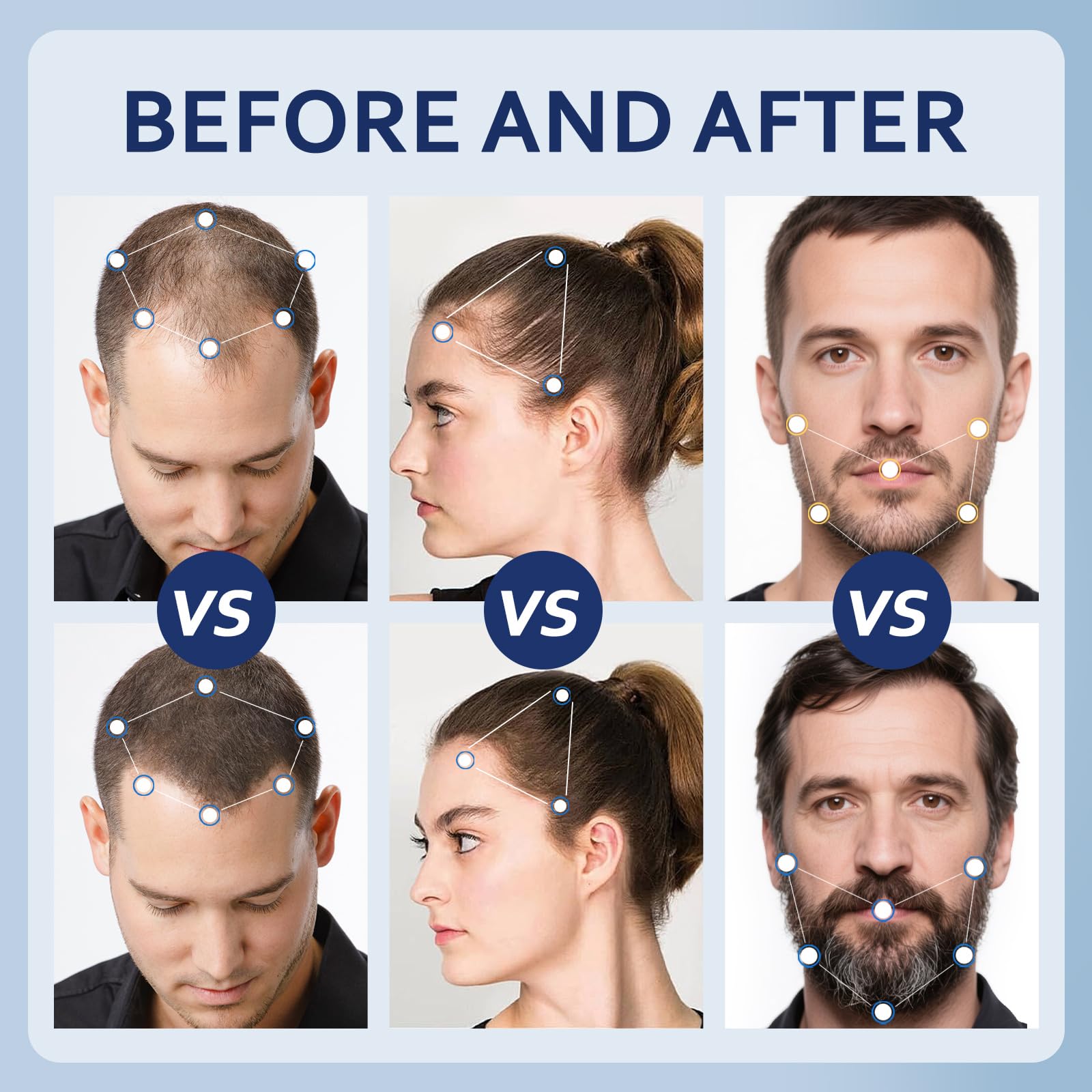 Artimore aplicación en cuero cabelludo, ayuda a distribuir minoxidil en zonas finas