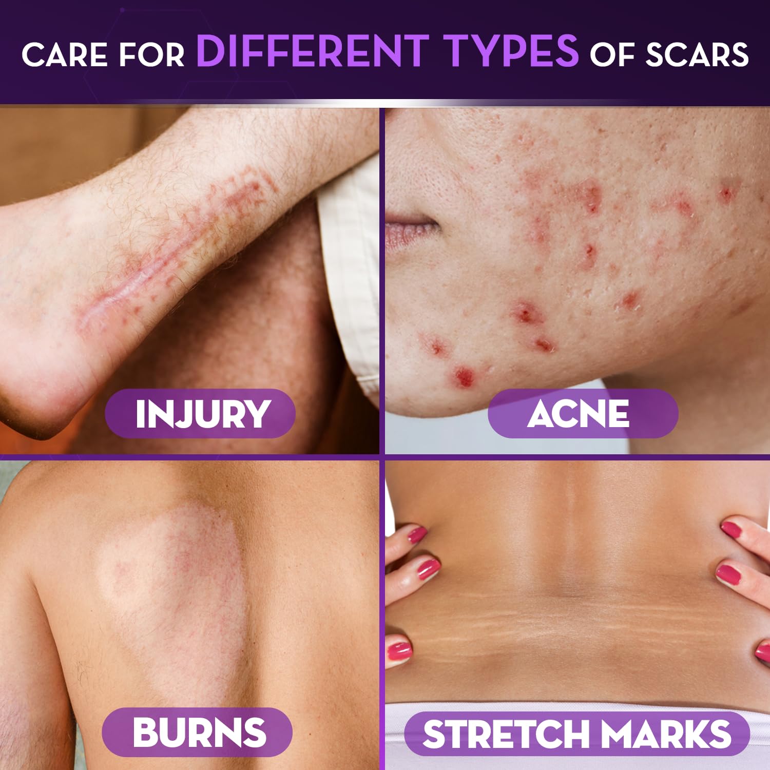 Cicatricure being applied to forearm to improve scar appearance