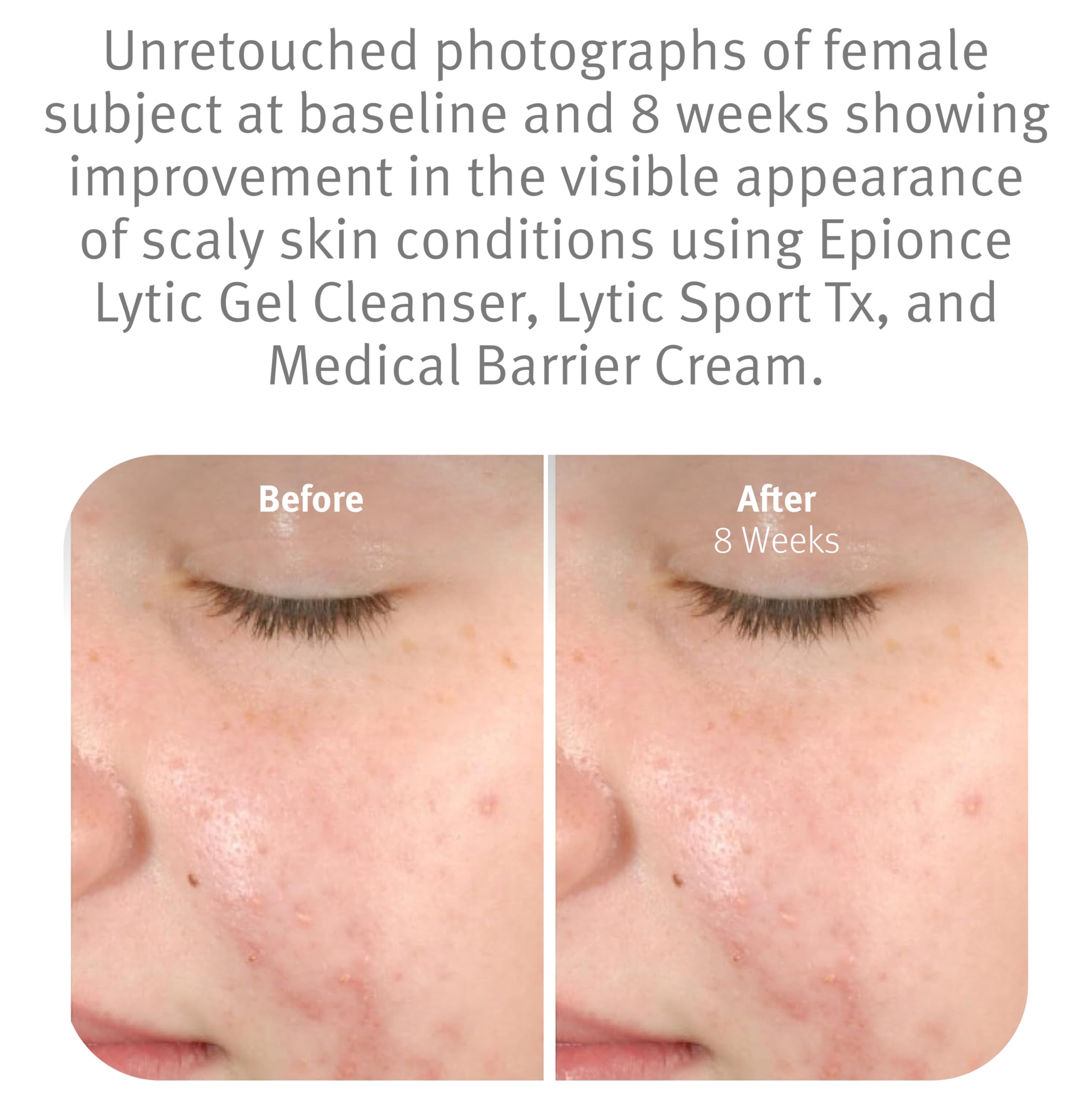 Espuma ligera de Epionce Lytic Gel en mano que disuelve maquillaje
