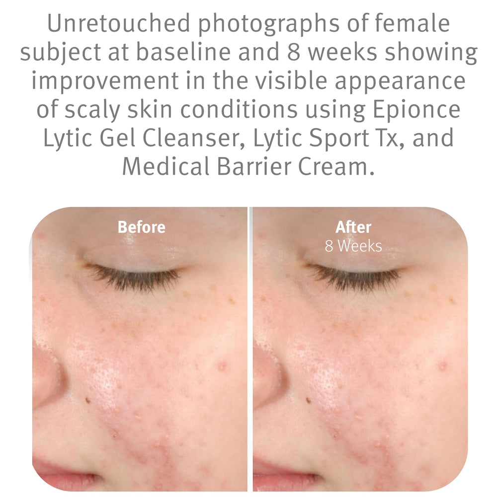 Espuma ligera de Epionce Lytic Gel en mano que disuelve maquillaje