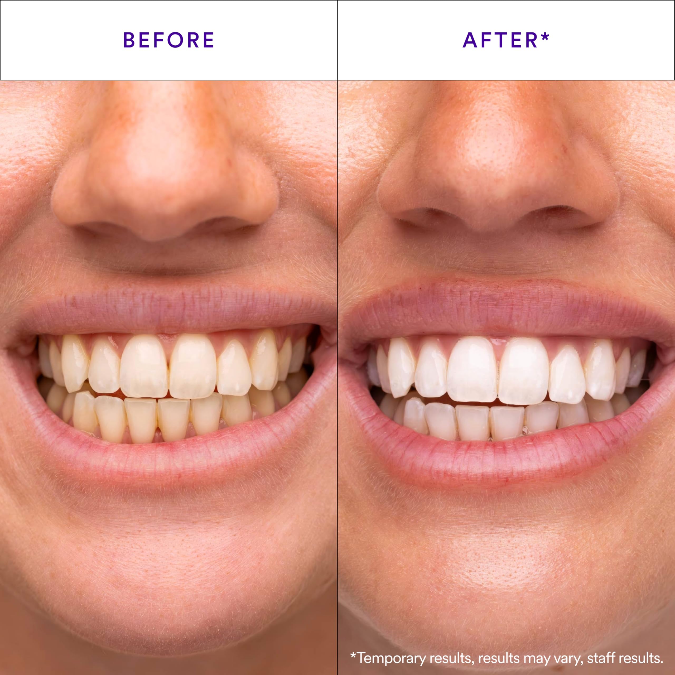 HISMILE V34 tira morada adherida a dientes, aplicación estable y cómoda