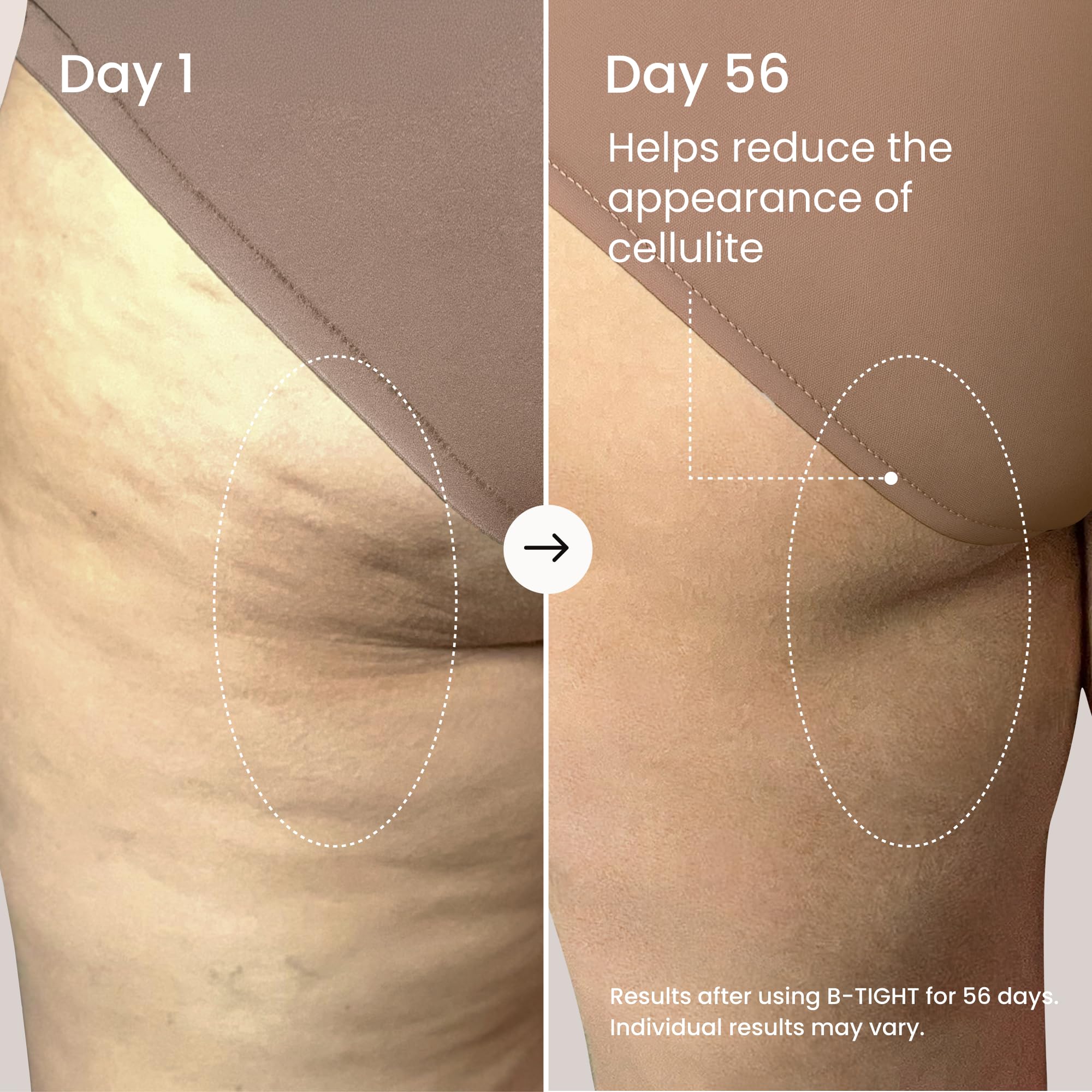 MAËLYS aplicación de B-TIGHT en muslos tras ducha mejora textura al instante