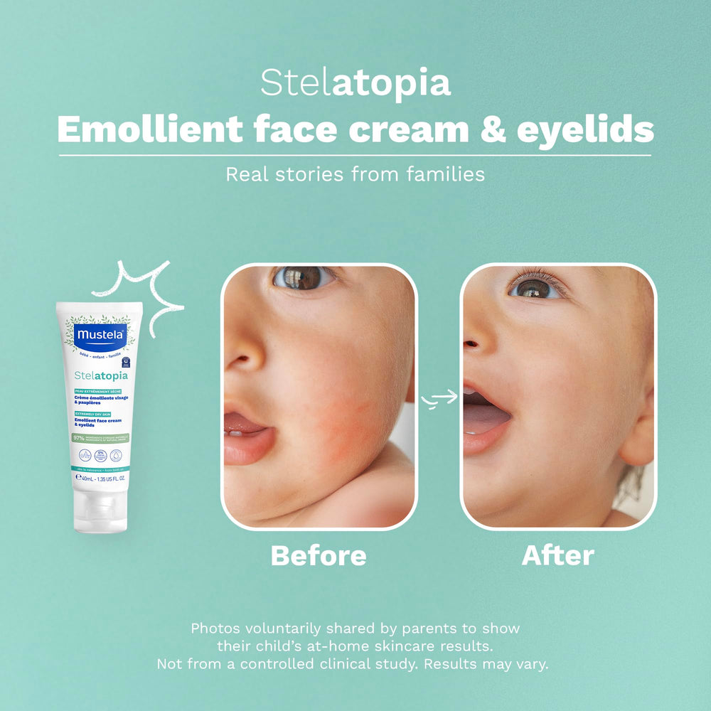 Mustela aplicación en bebé rostro para aliviar picor y enrojecimiento