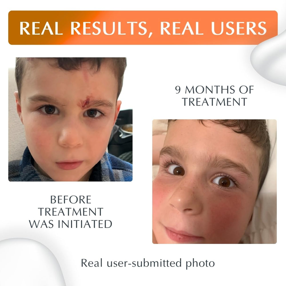 MyNewGel crema en uso sobre cicatriz facial para protección y mejora visible