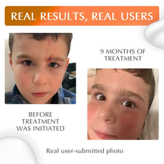 MyNewGel crema en uso sobre cicatriz facial para protección y mejora visible
