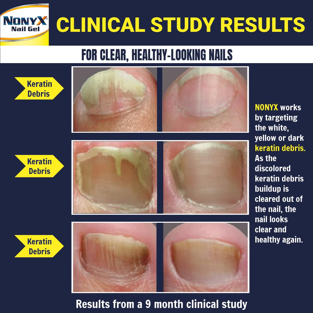Persona aplicando NONYX en uñas de los pies, producto fácil y rápido