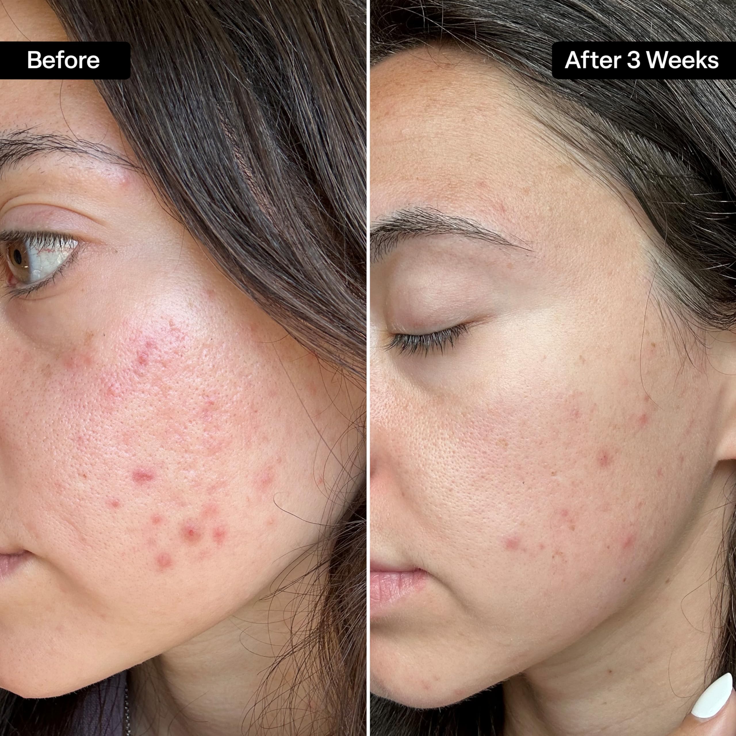 QRxLabs ingredientes activos 2% salicílico 10% glicólico y vitaminas para renovar piel