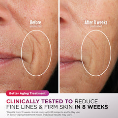 Shark CryoGlow en uso sobre rostro demostrando tratamiento cómodo