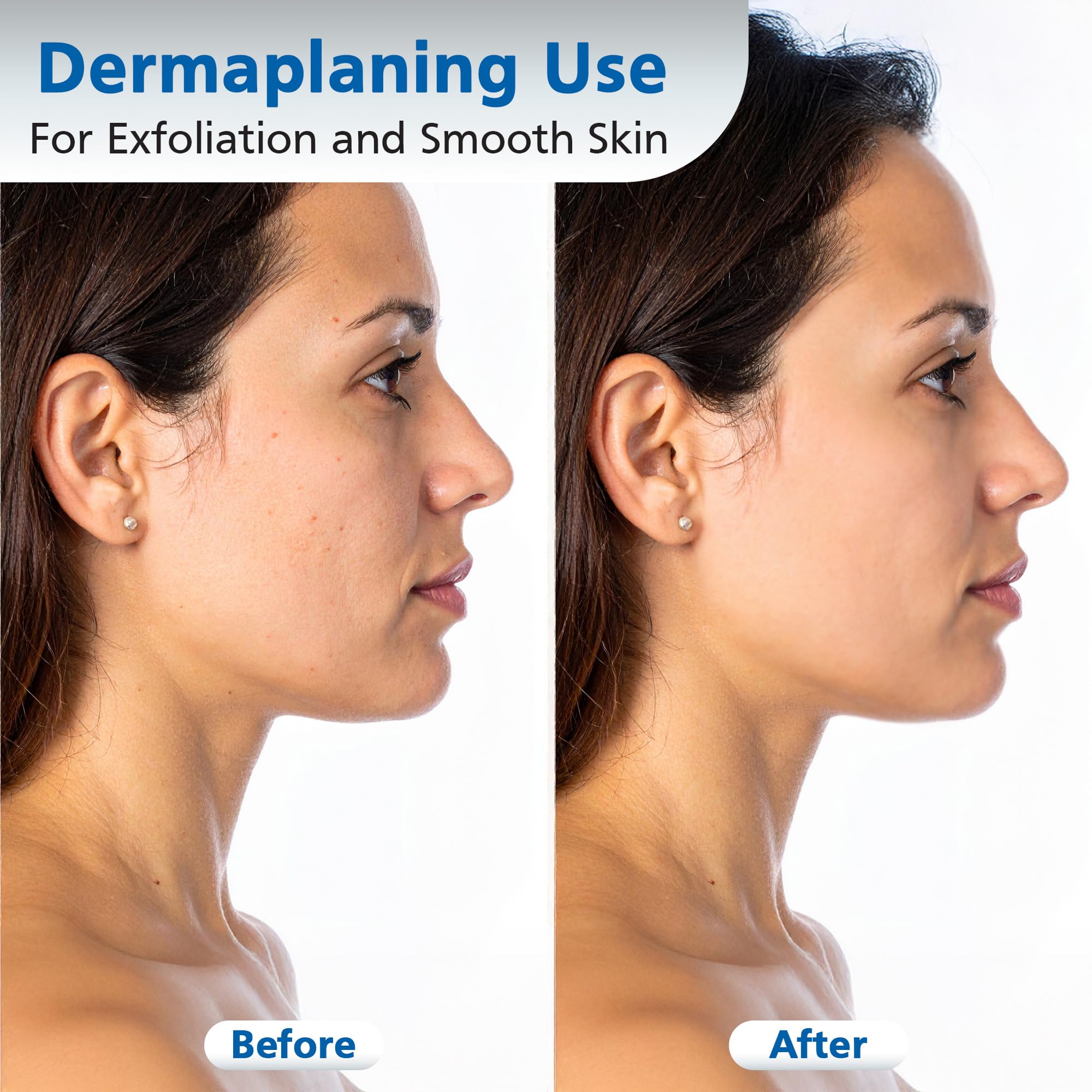 Swann-Morton demostración en mano durante dermaplaning para control óptimo