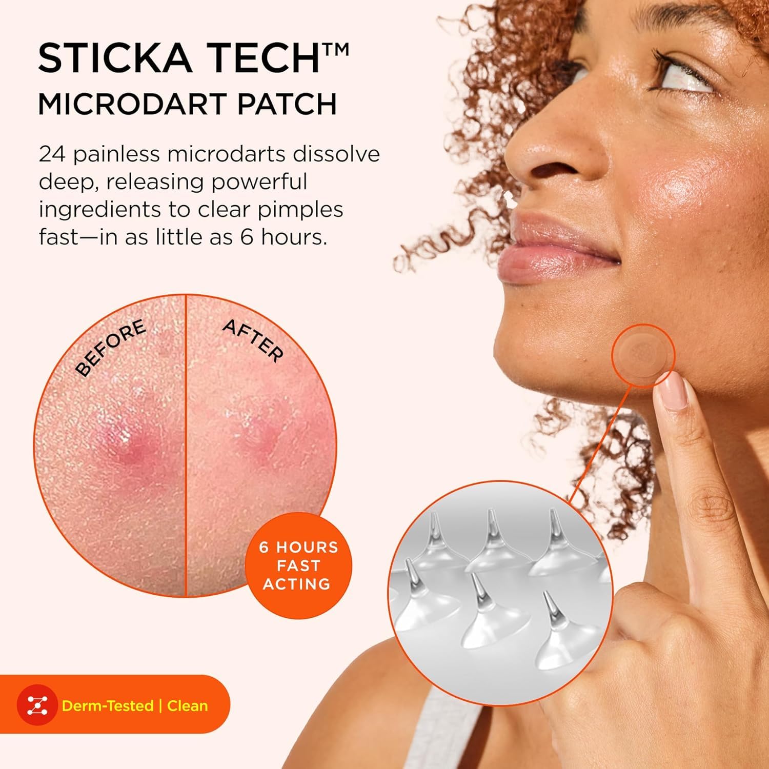 ZitSticka primer plano microdardos visibles en el parche, eficacia localizada